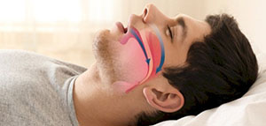 صورة: أسباب الاختناق المرتبطة بوضعية النوم و أسباب مرضية للاختناق أثناء النوم