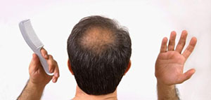 فراغات الرأس و أسباب ظهور فراغات في فروة الرأس صورة: فراغات الرأس و أسباب ظهور فراغات في فروة الرأس