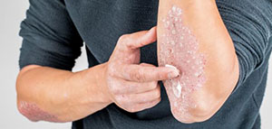 صورة: علاج الصدفية و نصائح وإرشادات و فيديو عن علاج الصدفية