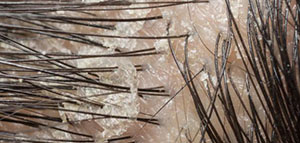 صورة: الأضرار التي تتسبب بها قشرة الشعر و أسباب قشرة الرأس