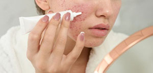 صورة: طرق طبية للتخلص من حب الشباب نهائيا و طرق طبية للتخلص من آثار حب الشباب نهائيا