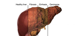صورة: الفرق بين تشمع الكبد وتليف الكبد من حيث التعريف