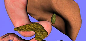 التهاب المرارة و أنواع التهاب المرارة صورة: التهاب المرارة و أنواع التهاب المرارة