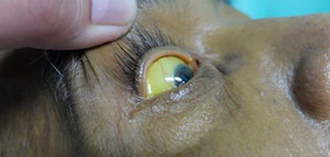 صورة: أعراض بوصفير و أعراض تستدعي مراجعة الطبيب