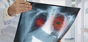 صورة: طرق علاج السرطان و هل يمكن استخدام الأعشاب لعلاج السرطان