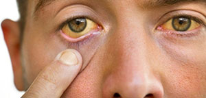 صورة: ما هو سبب اصفرار العين و اصفرار العين عند حديثي الولادة