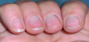 تكسر الأظافر و أسباب تكسر الأظافر و علاج تكسر الأظافر صورة: تكسر الأظافر و أسباب تكسر الأظافر و علاج تكسر الأظافر