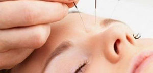 صورة: العلاج بالإبر الصينية و فوائد العلاج بالإبر الصينية