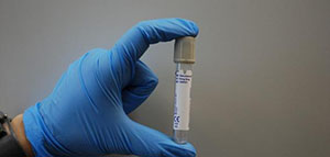 صورة: ارتفاع إنزيمات الكبد إلى 500 و أسباب ارتفاع إنزيمات الكبد