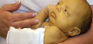 صورة: علاج الصفار عند المواليد و ملخص حول الصفار عند المواليد