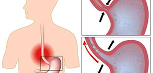 تعريف فتق المعدة و أعراض الإصابة بفتاق المعدة صورة: تعريف فتق المعدة و أعراض الإصابة بفتاق المعدة