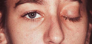 صورة: العصب السابع و أسباب العصب السابع و أعراض التهاب العصب السابع