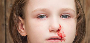 صورة: ما هو الرعاف و أنواع الرعاف و أعراض الرعاف