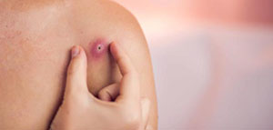 نصائح للتعامل مع الدمل في المنزل و علاج الدمل طبيا صورة: نصائح للتعامل مع الدمل في المنزل و علاج الدمل طبيا