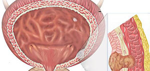 التهاب المثانة و أعراض التهاب المثانة صورة: التهاب المثانة و أعراض التهاب المثانة