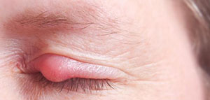 صورة: ما هو التهاب الجفن و ما هي أعراض التهاب الجفن