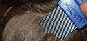 القمل و كيفية علاج القمل و طرق الوقاية من القمل صورة: القمل و كيفية علاج القمل و طرق الوقاية من القمل