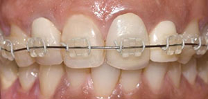 صورة: تقويم الأسنان و تقويم الأسنان الشفاف