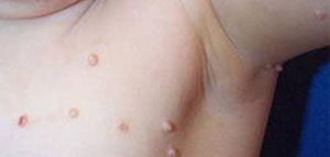 صورة: الزوائد الجلدية و أسباب ظهور الزوائد الجلدية