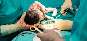 صورة: الولادة القيصرية و الولادة الطبيعية والولادة القيصرية