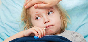 صورة: مرض الحصبة و أعراض مرض الحصبة و مضاعفات مرض الحصبة