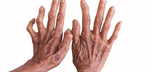 صورة: مرض الجذام و مضاعفات مرض الجذام و علاج مرض الجذام