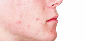 صورة: علاجات طبية لمشكلة حب الشباب و وصفات طبيعية لحل مشكلة حب الشباب