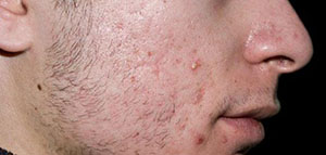 صورة: الهرمونات و نمو البكتيريا على البشرة