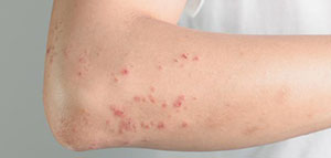 صورة: أعراض حساسية الجلد و أعراض تستدعي التدخل الطبي