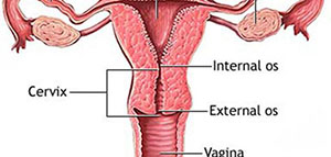 صورة: قرحة عنق الرحم و أسباب قرحة عنق الرحم