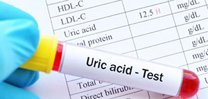 صورة: تحليل اليوريك أسيد و دواعي إجراء تحليل اليوريك أسيد