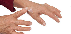 صورة: انتشار المرض و طريقة إمراضه و مواضيع اخرى عن مرض الروماتيزم