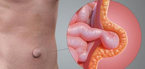 صورة: ما هو مرض الفتاق و ما هي أنواع الفتاق