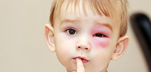 صورة: قرحة القرنية و أعراض قرحة القرنية و أسباب وعوامل خطر الإصابة بقرحة القرنية