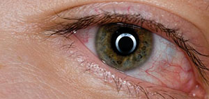 صورة: ماذا يعني التهاب الملتحمة و ما هي أعراض التهاب الملتحمة