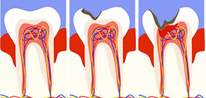 صورة: حشو العصب و أسباب حشو العصب و طريقة حشو العصب