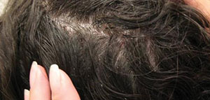 صورة: القمل و طرق تخليص الشعر من القمل وبيوضه