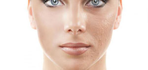 صورة: البشرة الجافة