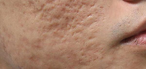 صورة: البشرة و طرق طبيعية لعلاج حفر الوجه السطحية