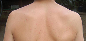 صورة: طرق طبية للتخلص من آثار الحبوب و طرق طبيعية للتخلص من آثار الحبوب