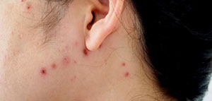 صورة: أعراض جدري الماء عند الحامل و مضاعفات جدري الماء عند الحامل